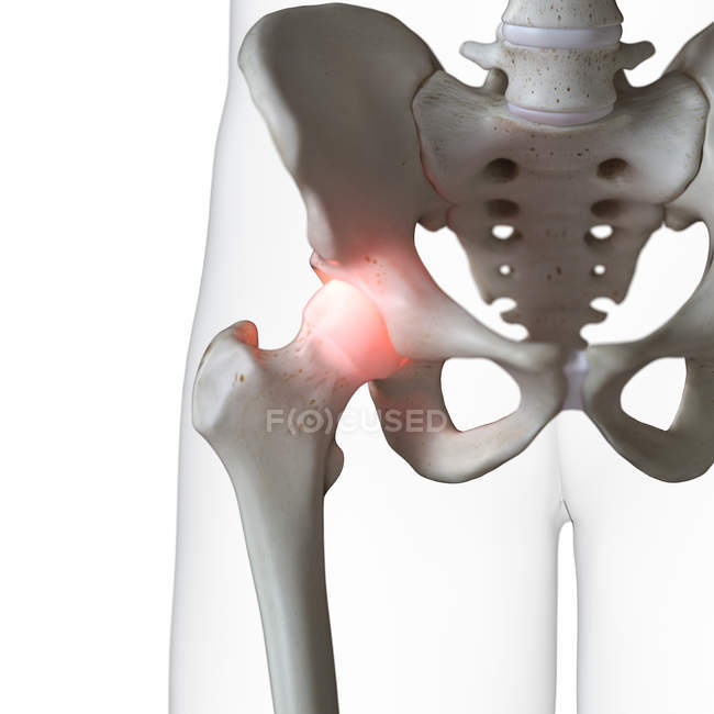 Digital illustration of painful hip joint in human skeleton. — Stock Photo