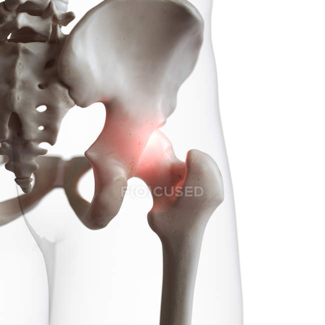 Digital illustration of painful hip joint in human skeleton. — Stock Photo