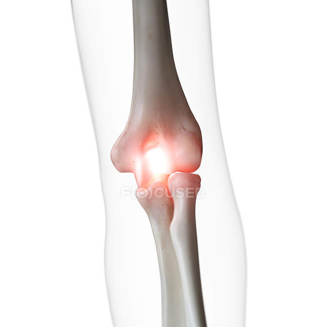 Digital illustration of painful elbow joint in human skeleton. — Stock Photo