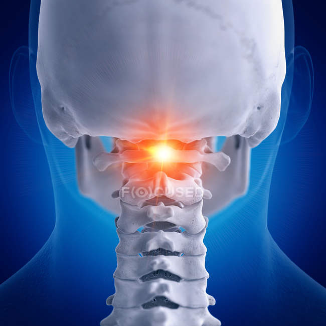 Digital illustration of painful atlas vertebrae in human skeleton. — Stock Photo