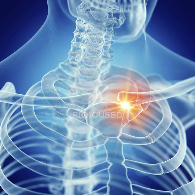 Illustration of painful clavicle in human skeleton. — Stock Photo