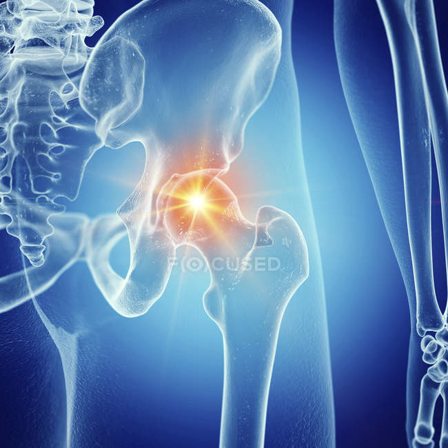 Illustrazione dell'articolazione dolorosa dell'anca nello scheletro umano . — Foto stock