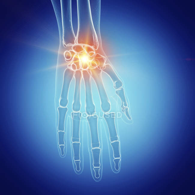 Darstellung des schmerzhaften Handgelenks im menschlichen Skelett auf blauem Hintergrund. — Stockfoto