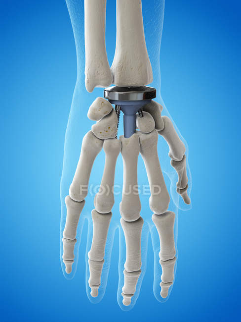 Ilustração da substituição do pulso no fundo azul . — Fotografia de Stock