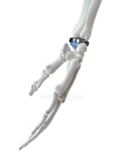 Illustration of wrist replacement on white background. — Stock Photo