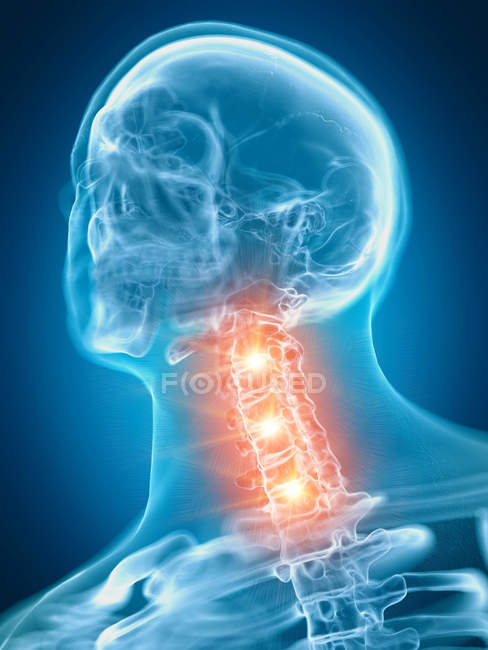 Illustration de la colonne cervicale douloureuse dans la partie du squelette humain . — Photo de stock