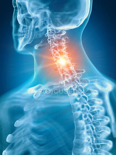 Иллюстрация болезненного шейного отдела позвоночника в части скелета человека . — стоковое фото