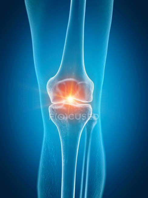 Illustration of painful knee in human skeleton part. — Stock Photo
