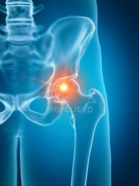 Illustration d'une articulation douloureuse de la hanche dans le squelette humain . — Photo de stock