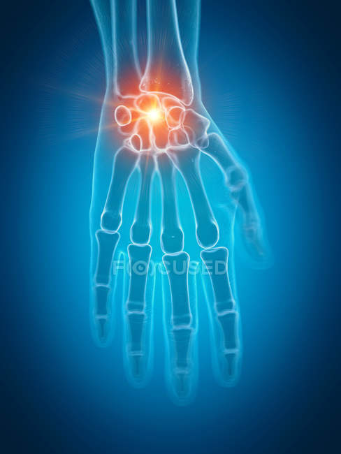 Illustration of painful wrist in human skeleton part. — Stock Photo