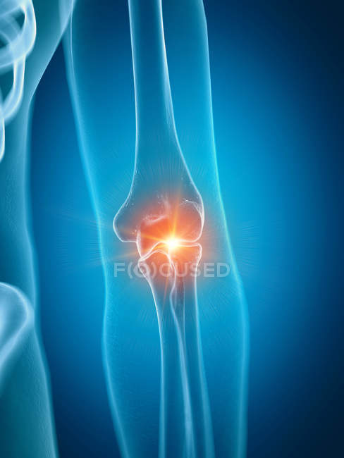 Illustrazione dell'articolazione dolorosa del gomito nella parte dello scheletro umano . — Foto stock