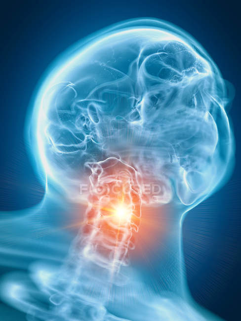 Illustrazione del collo doloroso nella parte dello scheletro umano . — Foto stock