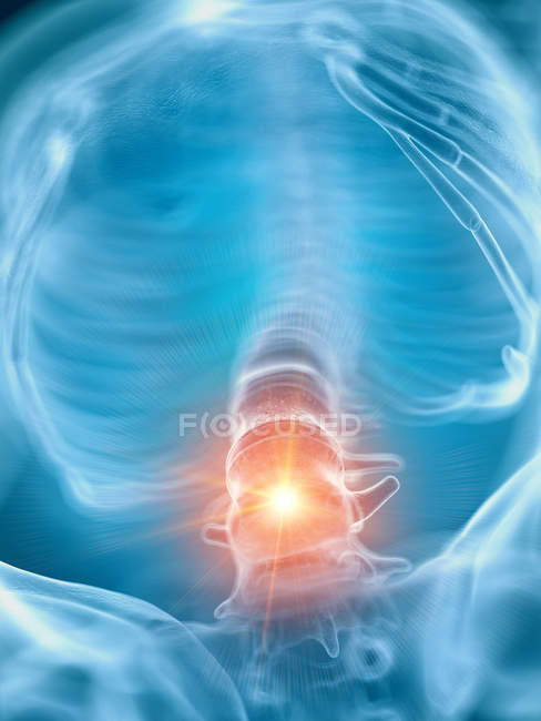Иллюстрация болезненной нижней части позвоночника человека
. — стоковое фото