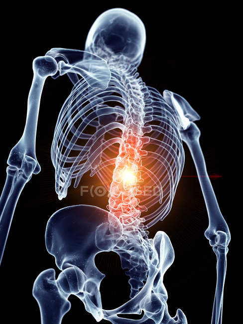 Illustration der schmerzhaften Wirbelsäule im menschlichen Skelettteil. — Stockfoto