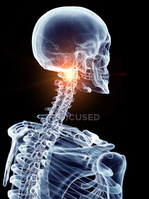 Illustrazione della colonna vertebrale cervicale dolorosa nella parte scheletrica umana . — Foto stock