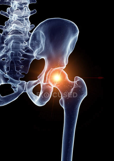 Ilustración de la articulación dolorosa de la cadera en la parte esquelética humana . - foto de stock