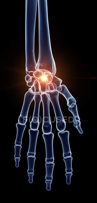 Illustration des schmerzhaften Handgelenks im menschlichen Skelettteil. — Stockfoto