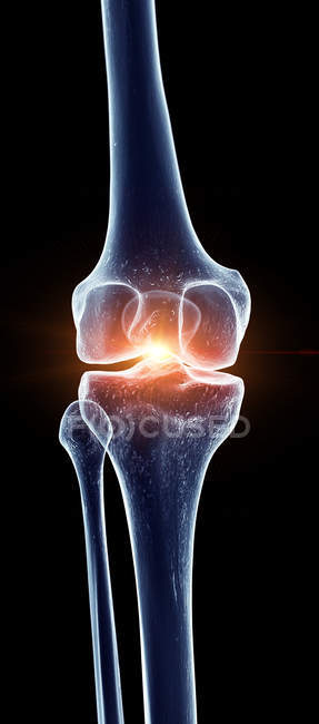 Ilustración de la articulación dolorosa de la rodilla en la parte esquelética humana . - foto de stock