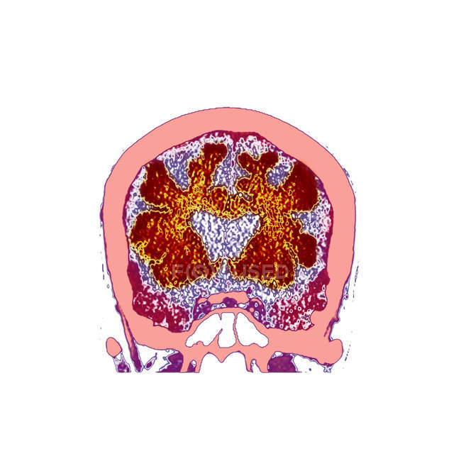 Кольорове комп'ютерне томографічне сканування ділянки через мозок старшого пацієнта чоловічої статі з деменцією . — стокове фото