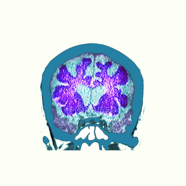 Tomografía computarizada coloreada de sección a través del cerebro de un paciente varón mayor con demencia
. - foto de stock