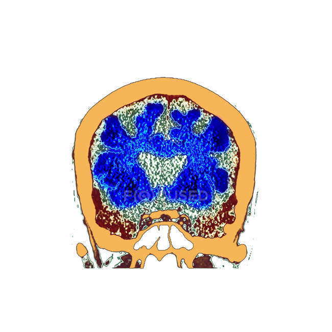 Tomografía computarizada coloreada de sección a través del cerebro de un paciente varón mayor con demencia . - foto de stock