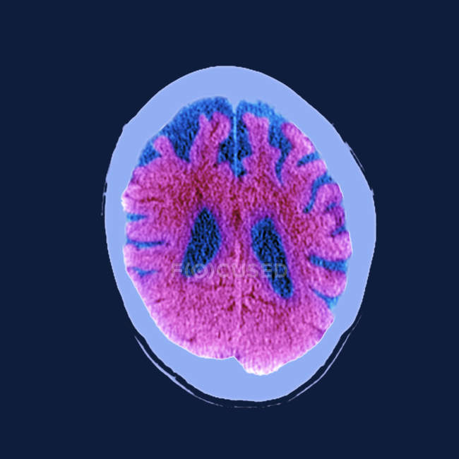 Farbige Computertomographie des Schnitts durch das Gehirn eines älteren männlichen Patienten mit Demenz. — Stockfoto