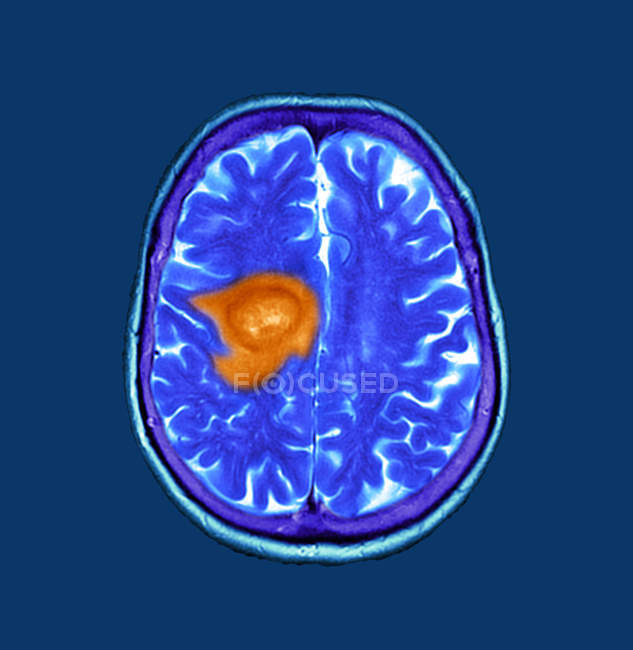 Синій кольорові комп'ютерної томографії сканування мозку розділу старший пацієнтки гліобластомі рак мозку. — стокове фото