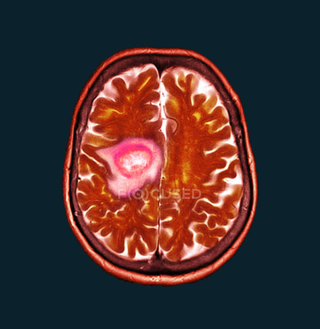 Red colored computed tomography scan of brain section of senior female patient with glioblastoma brain cancer. — Stock Photo