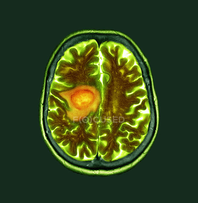 Зелений кольорові томографію сканування мозку розділу старший пацієнтки гліобластомі рак мозку. — стокове фото