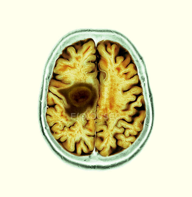Жовта кольоровими томографію сканування мозку розділу старший пацієнтки гліобластомі рак мозку. — стокове фото