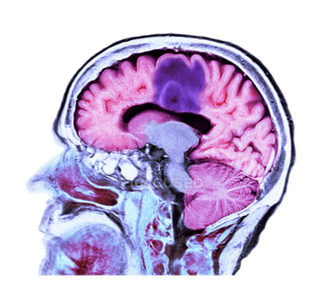 Tomografía computarizada coloreada de la sección cerebral de una paciente mayor con cáncer de cerebro de glioblastoma . - foto de stock