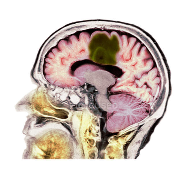 Tomografia computerizzata colorata della sezione cerebrale della paziente anziana con glioblastoma cancro al cervello . — Foto stock