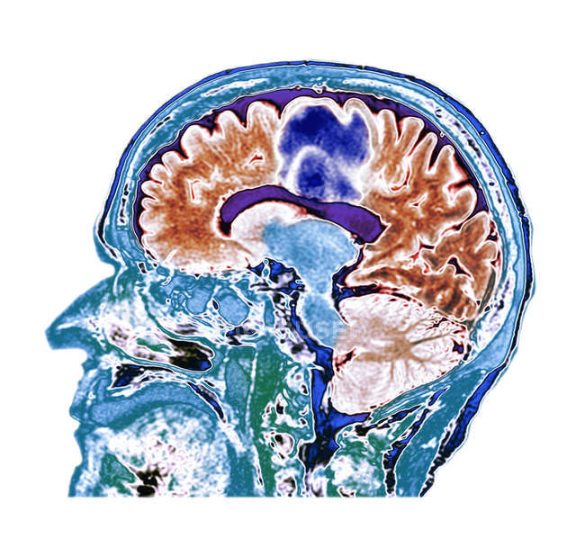 Farbige Computertomographie des Gehirnschnitts einer älteren Patientin mit Glioblastom-Hirntumor. — Stockfoto