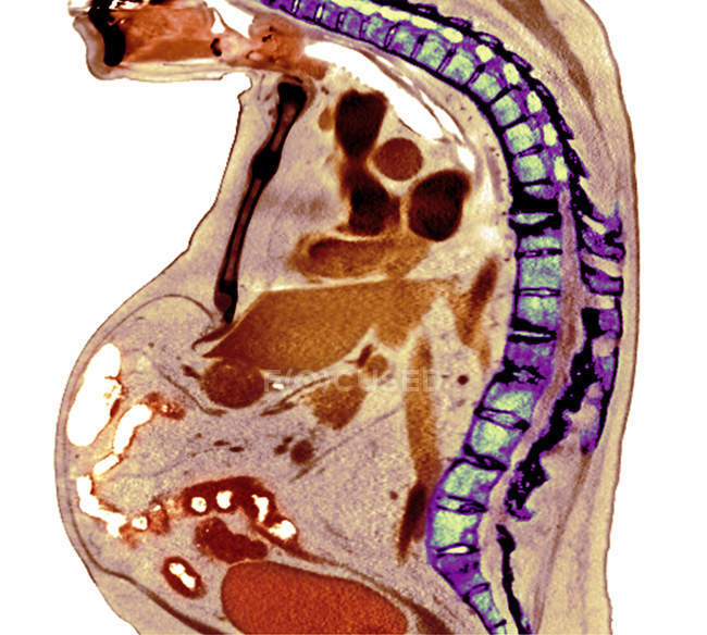 Radiographie colorée de la section à travers la colonne thoracique du patient âgé de sexe masculin atteint de spondylarthrite ankylosante avec dégénérescence sévère de la colonne thoracique inférieure
. — Photo de stock