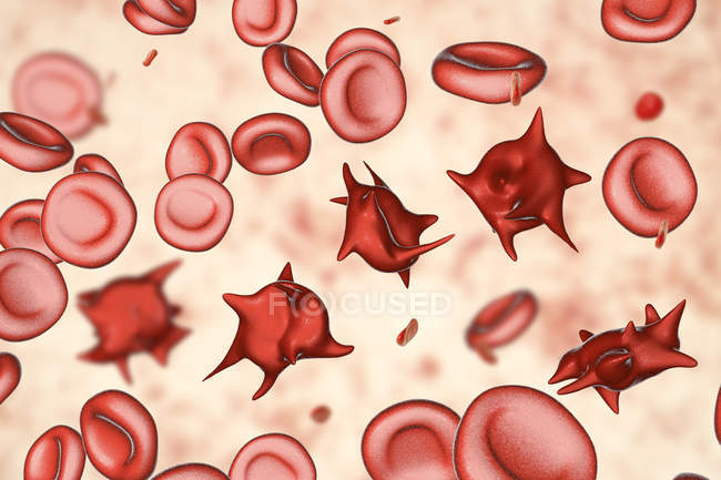 Иллюстрация аномальных красных кровяных телец, известных как акантоциты шпоры
. — стоковое фото