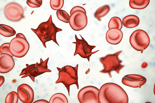 Ілюстрація ненормальні еритроцитів відомий як стимул клітин acanthocytes. — стокове фото
