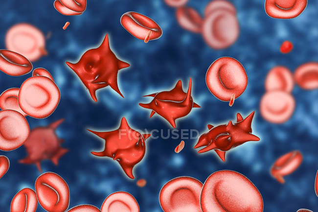 Иллюстрация аномальных красных кровяных телец, известных как акантоциты шпоры
. — стоковое фото