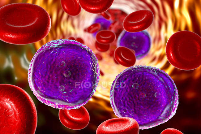Digitale Illustration zeigt reichlich vorhandene Lymphoblastenzellen im menschlichen Blut bei akuter lymphoblastischer Leukämie. — Stockfoto