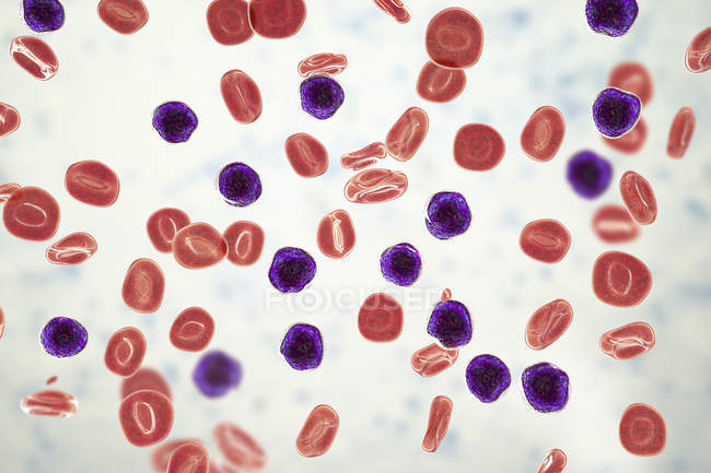 Цифровая иллюстрация, показывающая обильные лимфобластные клетки в крови человека при остром лимфобластном лейкозе
. — стоковое фото