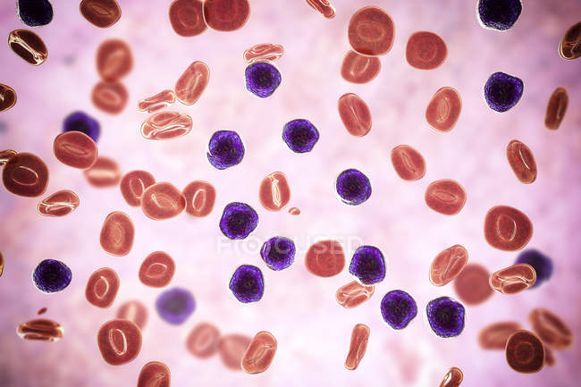 Цифровий ілюстрація рясні lymphoblast клітин у крові людини в гострої лейкемії лімфобластний. — стокове фото