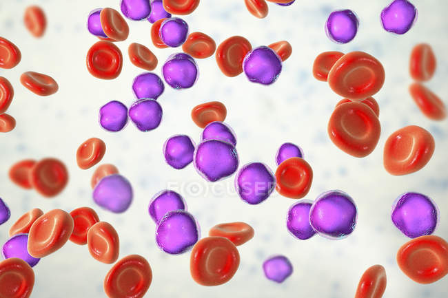 Illustration colorée montrant les cellules lymphoblastiques abondantes dans le frottis de moelle osseuse humaine dans la leucémie lymphoblastique aiguë
. — Photo de stock