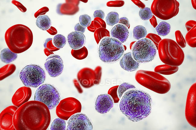 Illustrazione a colori che mostra abbondanti cellule linfoblastiche nello striscio di midollo osseo umano nella leucemia linfoblastica acuta
. — Foto stock
