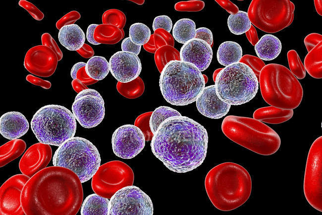 Ilustración coloreada que muestra células linfoblásticas abundantes en frotis de médula ósea humana en leucemia linfoblástica aguda . - foto de stock