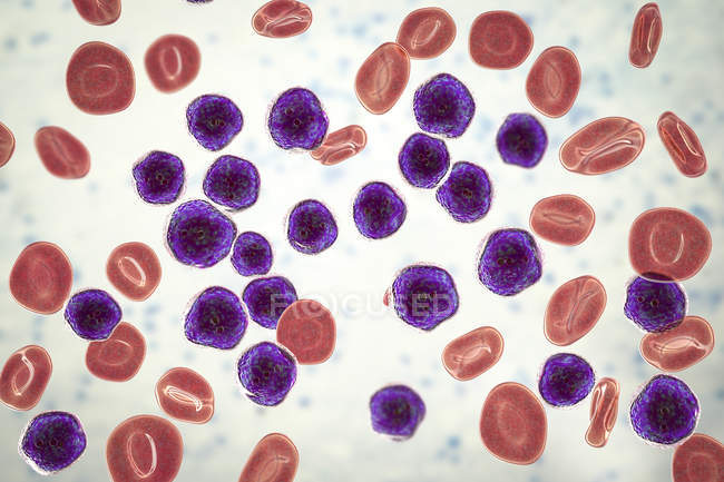 Кольорові ілюстрації показ рясні lymphoblast клітин в людському кісткового змастити в гострої лейкемії лімфобластний. — стокове фото