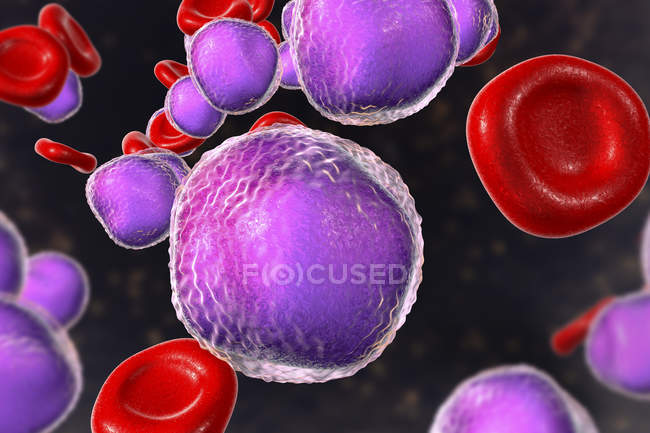 Colored illustration showing abundant lymphoblast cells in human bone marrow smear in acute lymphoblastic leukaemia. — Stock Photo