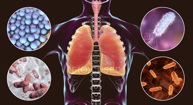 Цифровий ілюстрація бактерій, що викликають внутрішньолікарняна пневмонії золотистого стафілокока синьогнійна паличка, Klebsiella pneumoniae, кишкова паличка. — Stock Photo