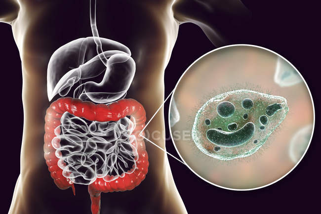 Digital illustration showing close-up of ciliate protozoan Balantidium coli intestinal parasite causing balantidiasis ulcer in human intestinal tract. — Stock Photo