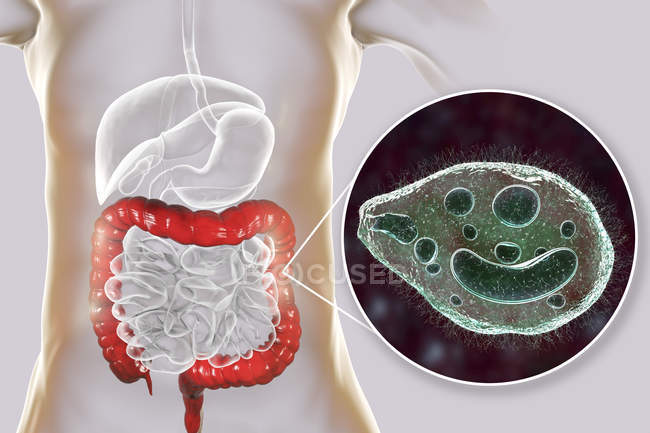 Ilustración digital que muestra el primer plano del protozoario ciliado Balantidium coli parásito intestinal que causa úlcera por balantidiasis en el tracto intestinal humano
. - foto de stock