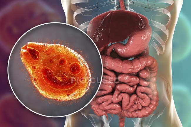 Ilustración digital que muestra el primer plano del protozoario ciliado Balantidium coli parásito intestinal que causa úlcera por balantidiasis en el tracto intestinal humano
. - foto de stock