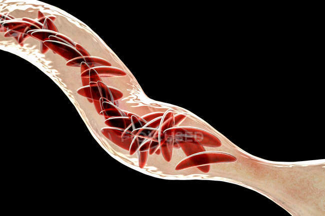 Иллюстрация красных кровяных телец, пораженных серповидноклеточной анемией с клетками полумесяца
. — стоковое фото